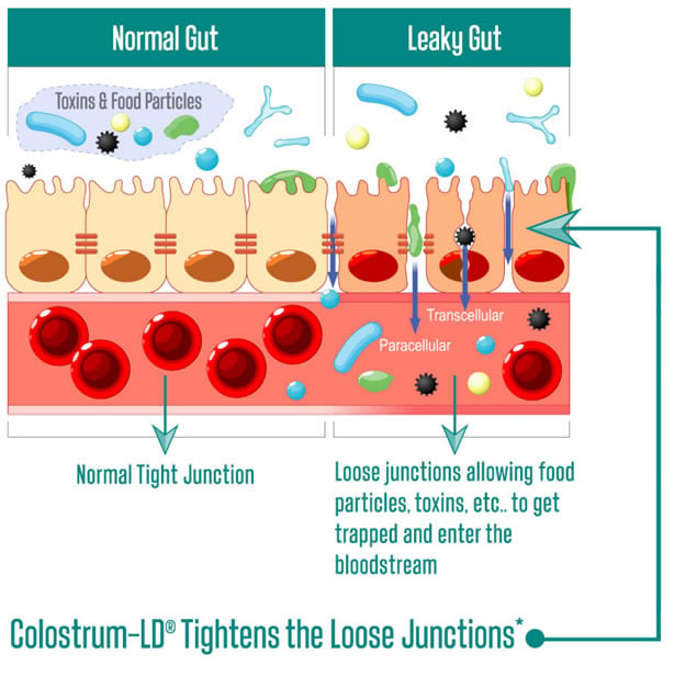 Leaky Gut Infographic